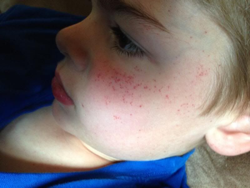 amoxicillin rash babycenter