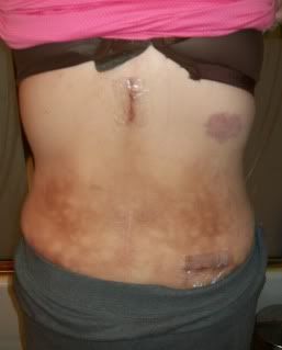 SURGERY,BACK,SPINAL CHORD STIMULATOR,SCARS,HEATING PAD SCARS