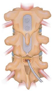 spine,spinal cord stimulator