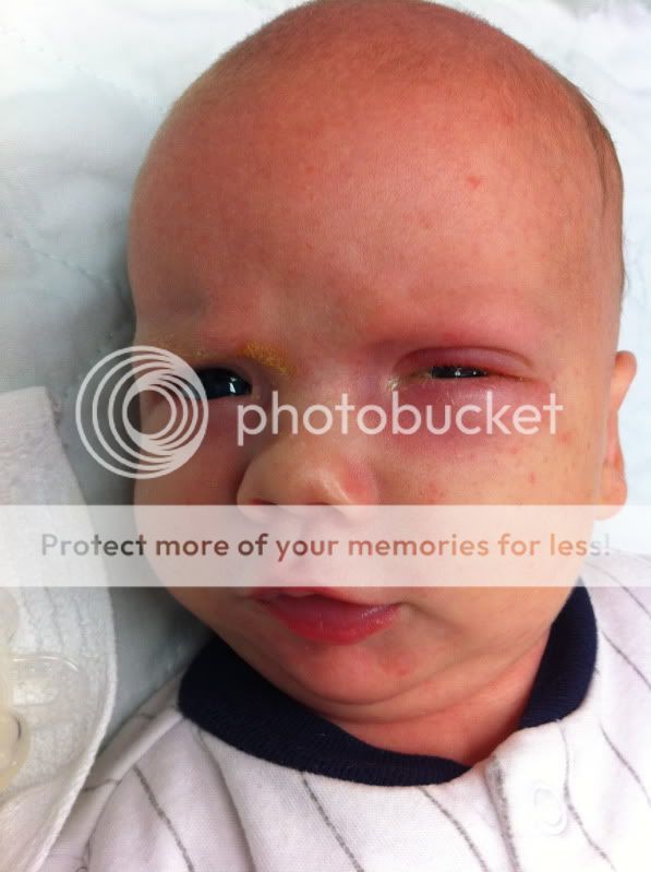 Goopy eye? BabyCenter